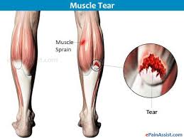 Pin On Leg Pain
