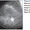 Breast ultrasound is not usually done to screen for breast cancer. 1