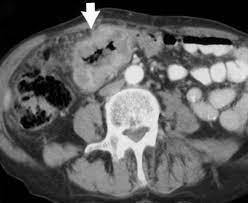 Cancer in cats is the leading cause of death among cats. Spiral Ct Of Colon Cancer Imaging Features And Role In Management Radiographics