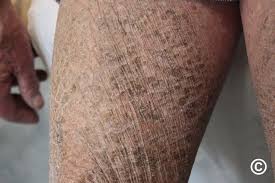 Image result for Ichthyosis