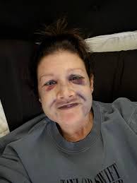 Has anyone experienced severe bruising after ablation procedure?