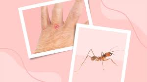 Image result for Fire Ant Sting