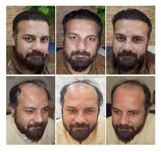 Salman Khan Fue Hair Transplant With Hair Plus International Hair Transplant Center Facebook After taking a brief look for myself i would say that it is absolutely possible that he did have a hair transplant to achieve these results.