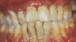 Cara menghilangkan karang gigi dengan scaling. Cara Hilangkan Karang Gigi Paling Mudah Dan Murah Periodontitis Dentaltown Dental