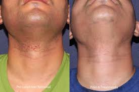 The most common side effects of laser hair removal treatment are: Gentlemax Pro Laser Skin Treatment San Diego Ca Clderm