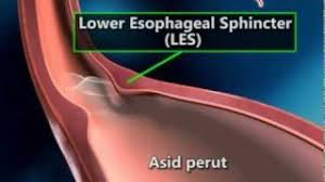 Petua nak hilangkan pedih ulu hati. Petua Semulajadi Ubati Pedih Ulu Hati Dan Gastrik Dengan 7 Bahan Bahan Ini Kartel Dakwah