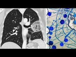 Symptoms depend on where in the body the infection occurs. Pulmonale Mukormykose Youtube