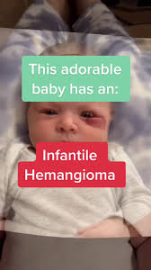 Hemangioma Babies Dla