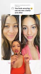 Transformation with Lip Filler Before and After in Guyana