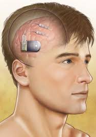 Article On Devices To Control Epilepsy Vns Deep Brain Stimulator Neuropace Epilepsy Treatment Epilepsy Epilepsy Surgery