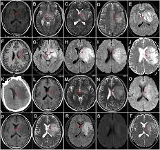 Image result for Brain Abscess