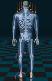 Image result for Functional Leg Length Discrepancy