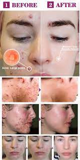 Remove Facial Oil And Reduce The Growth Of Acne Facial Oil How To Get Rid Of Acne How To Get Rid Of Pimples