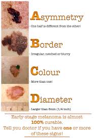 moles vs melanoma how to spot the difference sunspots