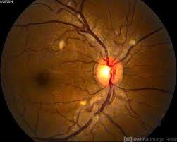 Image result for HIV Retinitis