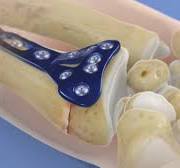 Distal Radius Fracture Repair with Volar Plate - Health ...