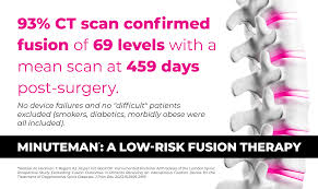 The Minuteman Procedure
