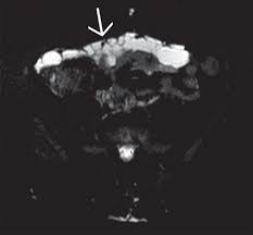 Two frequent types of mesenteric cysts are of lymphatic and. Benign Multicystic Peritoneal Mesothelioma Airp Best Cases In Radiologic Pathologic Correlation Radiographics
