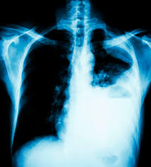 Fibroza pulmonară idiopatică este o boală pulmonară debilitantă și cu un prognostic destul de grav această afecțiune este o boală rară, de cauză necunoscută, iar termenul idiopatică traduce cauza. Solo El 40 De Los Pacientes Con Fibrosis Pulmonar Idiopatica Sobrevive A Los Cinco Anos