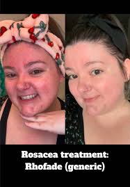 How to Remake Rochas Skin