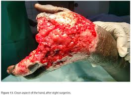 Whatever you have seen in a hollywood. Scielo Brasil Snakebite On The Hand Lessons From Two Clinical Cases Illustrating Difficulties Of Surgical Indication Snakebite On The Hand Lessons From Two Clinical Cases Illustrating Difficulties Of Surgical Indication