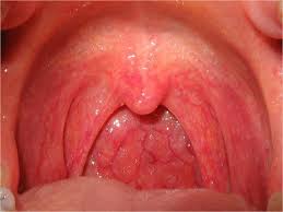 Image result for Tonsillitis