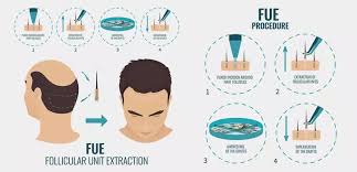 Get more information about hair transplant and plastic surgery in turkey. Hair Transplant In Turkey All Inclusive Packages