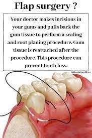 Flap Surgery Dentalhygienist Dtooth Ddentalclinic Oralhealth Dentalimplan Periodontitis Orthodontics Dental Clinic