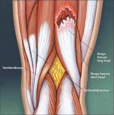 Strains are seen in all the quadriceps muscles but are most common in rectus femoris, which is more vulnerable to strain. Clinical Management Of Muscle Strains And Tears