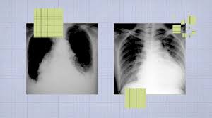 Image result for Chest XRay