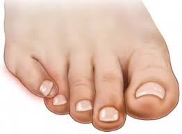 toe disorders in children podiatry