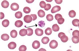 Purpura does not tend to appear and become itchy or irritated either. Mksap Quiz Petechial Rash Of The Lower Limbs Acp Internist