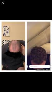 Treatment with finasteride can help prevent further hair loss. Tressless Pictures Scrolller