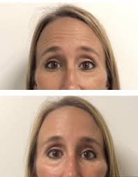 Goodbye Forehead Lines! 👋🏼👋🏼