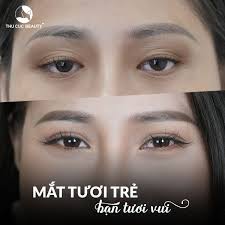 Mắt to mắt nhỏ là gì? Xấu hay đẹp? Có chữa được không?