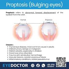 Image result for Proptosis