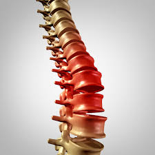 What Is My Va Disability Rating For Degenerative Disc Disease