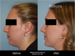 So, kybella does indeed generate results, but these caveats are important to keep in mind because they shape patient's expectations. Kybella Belkyra Injection Treatment In Toronto Spamedica