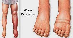 Fluid Retention Can Cause Swelling In Your Legs Ankles Feet And More But You Aren 39 T Water Retention Causes Water Retention Remedies Swollen Feet Remedy