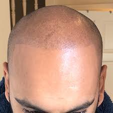 Scalp micropigmentation is a highly advanced, modern hair loss treatment for men that replicates real shaven hair follicles on the scalp. Sian Dellar Scalp Micropigmentation Smp Hair Tattoo London Harley St