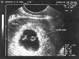 Üreme çağı içindeki çiftler korumasız cinsel ilişki yaşadıklarında erkeğin spermi ve kadının bebeğinizin cildini kaplayan kremsi madde yokolmaya başlamış, tüyler hemen hemen hiç kalmamıştır. Gebelikte Hamilelikte Ultrason Ile Yapilan Olcumler