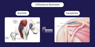 Image result for Bursitis