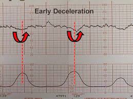 Electronic Fetal Heart Monitoring