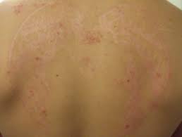 Henna body art has been a celebratory tradition in many countries for centuries. Black Henna Tattoo Reaction Dermnet Nz