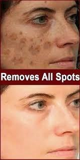 Find Out Who Is Worried About Remove Brown Spots And Why You Should Pay Attention Healthy Medicine Tips In 2020 Dark Spots On Skin Skin Spots Spots On Face