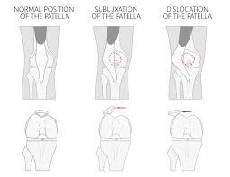 Image result for Patella Tracking Assessment