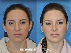 9 Parfitt Facial Cosmetic Surgery ideas