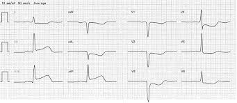 Myokarditis je onemocnění charakterizované zánětlivým infiltrátem srdečního svalu s nekrosou nebo s degenerací přilehlých myocytů. Myokardinfarkt Fokus Ekg