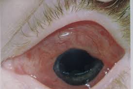 Image result for Acute Red Eye