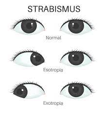 Our eyes are such a beautiful gift, so when a child is diagnosed with acute pediatric strabismus, it's natural that parents are concerned and want to help their if you are not sure whether your child's eyes are straight, ask your family doctor or a qualified eye care professional, who may refer you to an. Strabismus Portland Pediatric Eye Care Portland Oregon